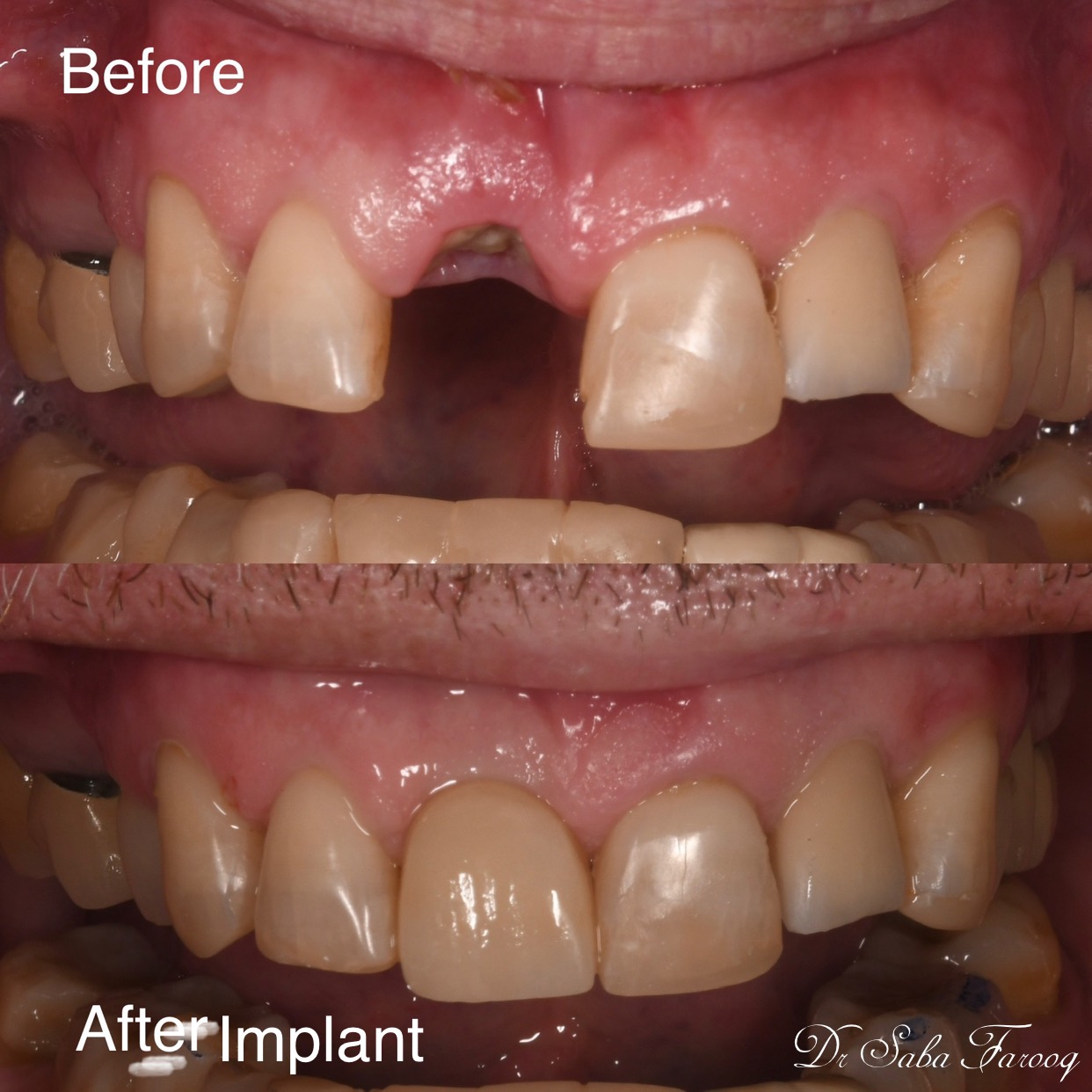 A before and after picture of a dental implant.