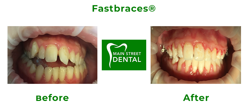 https://mainstreetdental.com.au/wp-content/uploads/2020/12/FastbracesImageWhite.png